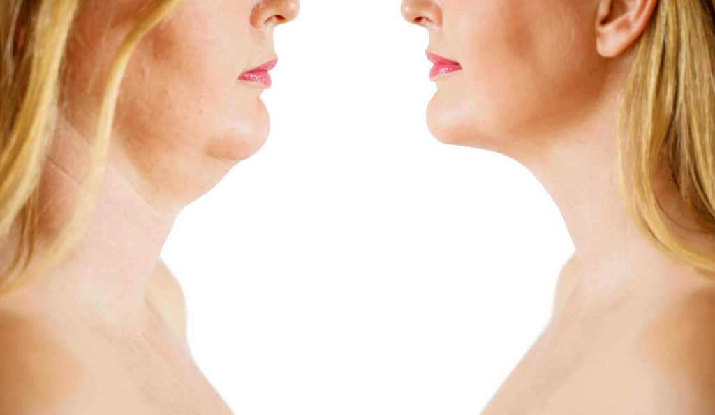 Double Chin treatment Southall before and after results
