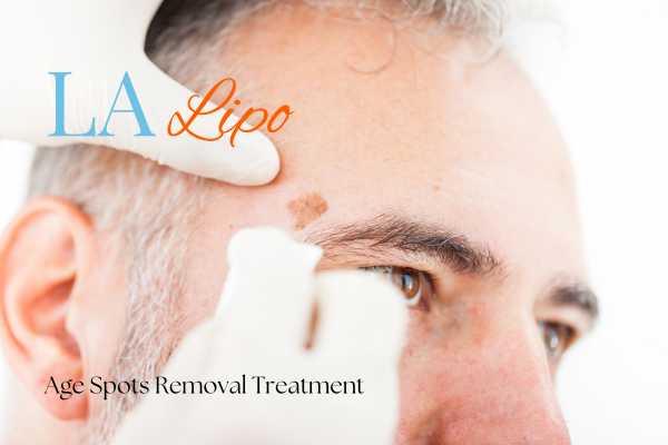 What Are the Most Effective Treatments for Age Spots Southall?