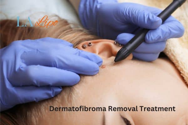 Dermatofibroma Removal Treatment Southall