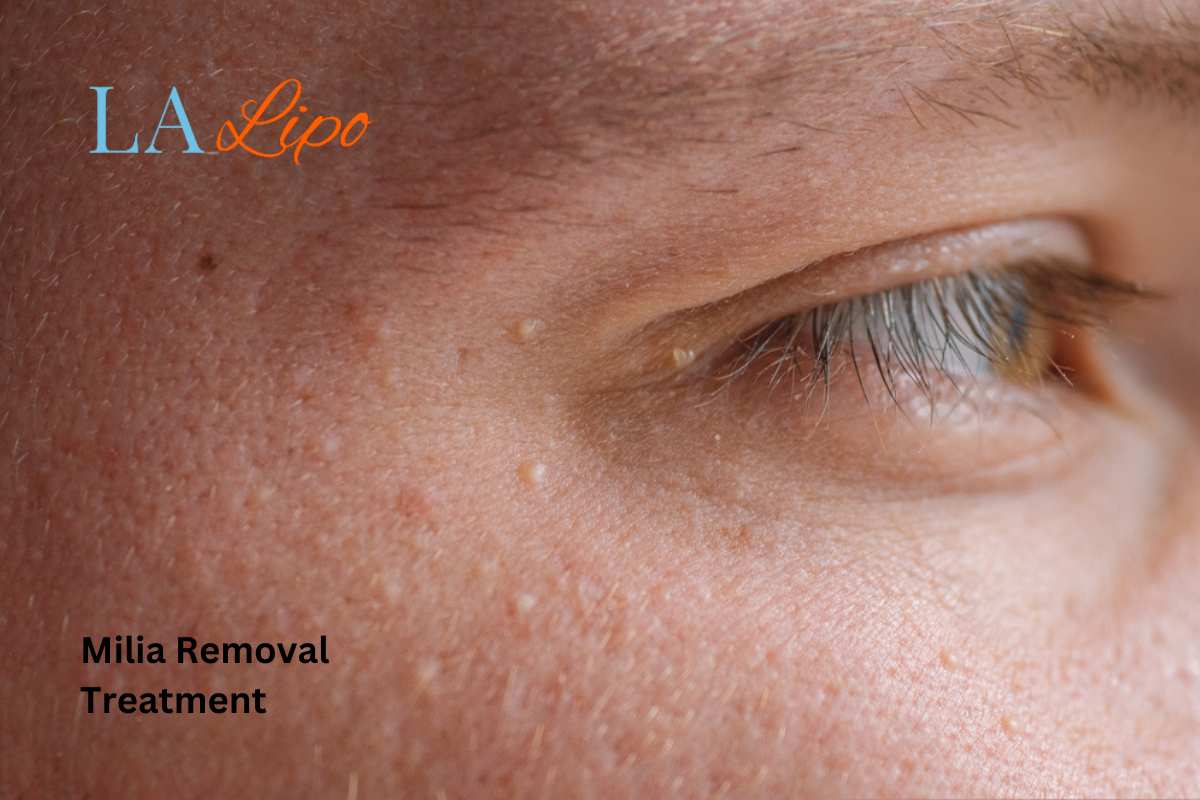 Cryopen Milia Removal: Is It the Easiest and Safest Option Southall?