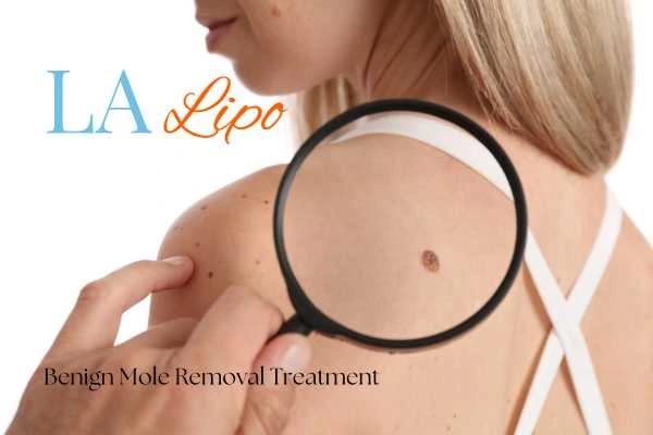 Why getting moles removed Southall can boost your confidence!