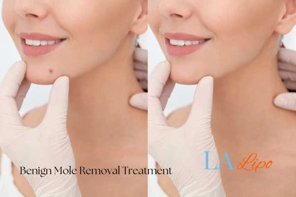 Woman's before and after results of being moles removal treatment Southall