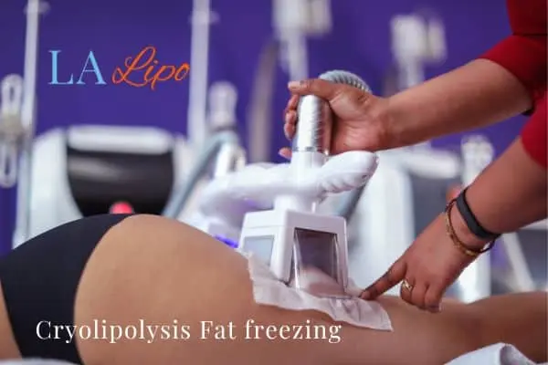 women getting fat freezing Southall