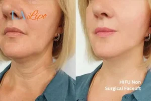 hi-fu for wrinkles Southall before and after results