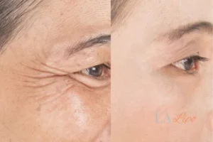 Before and after results of woman - HI-fu wrinkles reduction treatment Southall