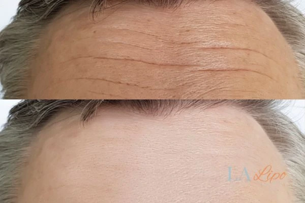 results of HIFU Southall on mans forehead to help reduce lines and wrinkles