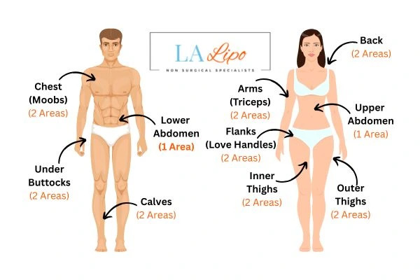 LA LIPO Cryolipolysis Areas Southall
