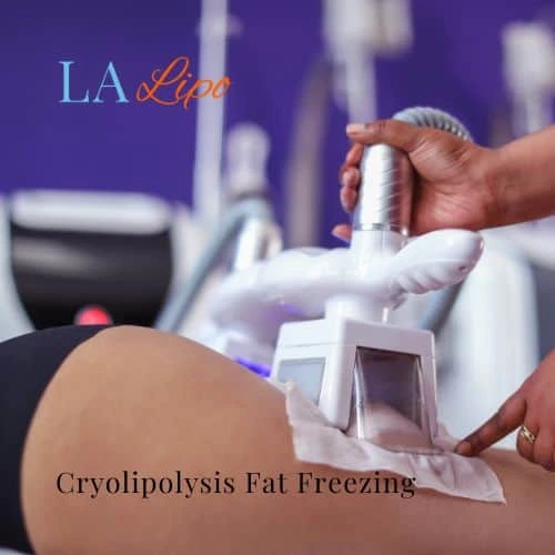 fat freezing - Cryolipolysis Southall