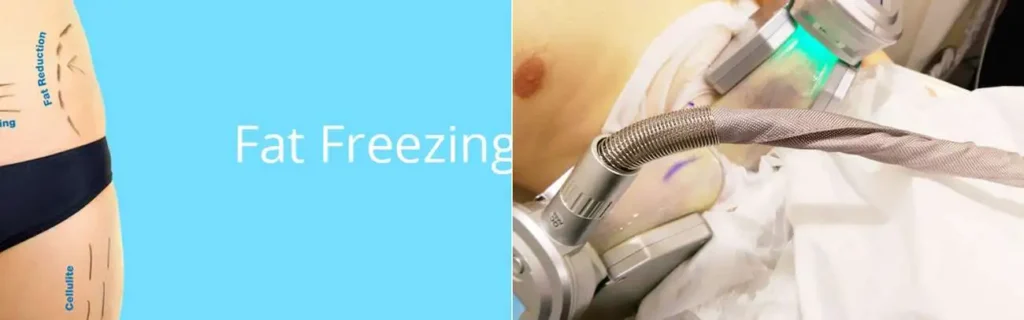 Fat freezing Southall on multiple areas of the body
