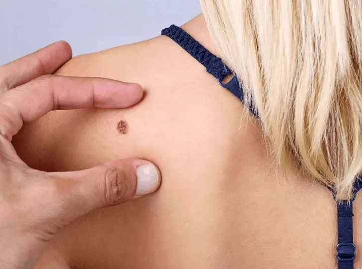 woman having mole removal Southall consultation before treatment.