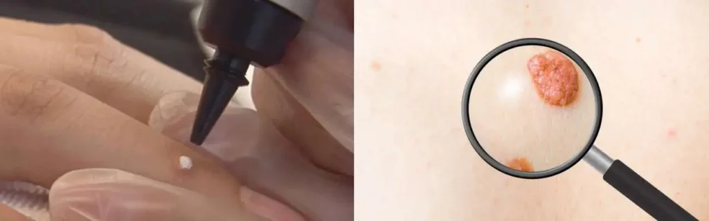 Cryopen for mole removal Southall - speak to our team today!