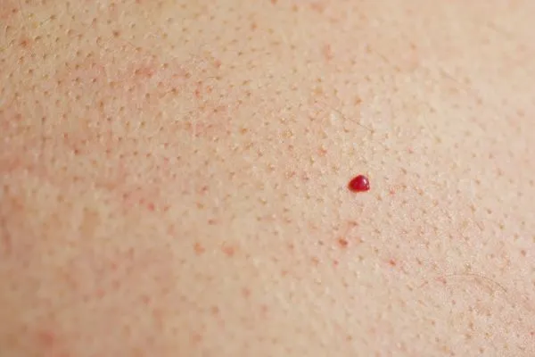 close up of a cherry angioma Southall