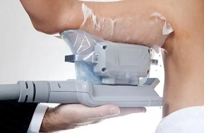 Picture of fat freezing Southall on the upper arms.