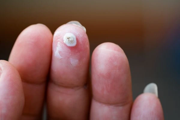 wart on person finger - cryotherapy to treat from LA LIPO Southall