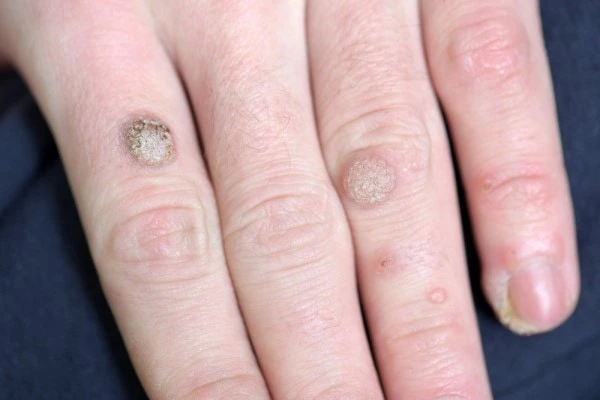 photo of warts on person hand - see wart removal Southall from LA LIPO