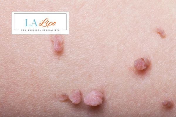 Does cryopen skin tag removal Southall hurt? Find out now call our team today!