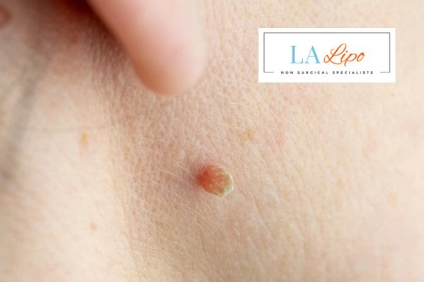 Book skin tag removal Southall today speak to our team now!