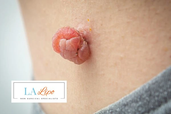Interested in skin tag removal Southall? Concerned about the pain? Find out more today!