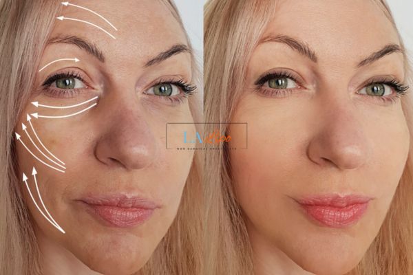 Morpheus 8 results Southall face lift.