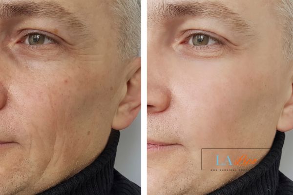 See the amazing results of Morpheus8 Treatment Southall!