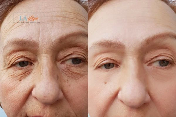 The powerful benefits of Morpheus8 Treatment Southall - Call Our team today!