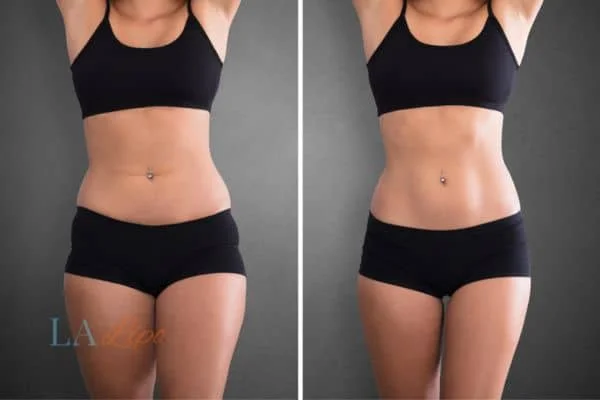 before and after results of non-surgical treatment to help a woman's body image and mental health Southall