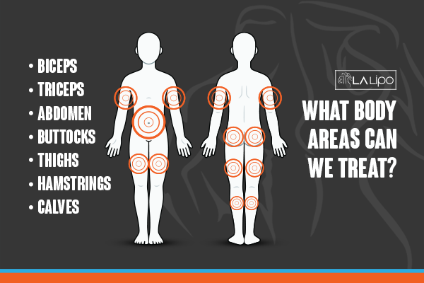 Diagram to show areas you can have LA-EMS Body Sculpting Treatment Southall