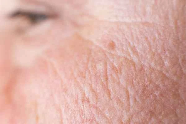 close up picture of a woman's face showing an age spot Southall