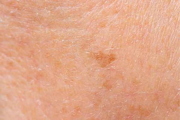 close up picture of age spots Southall