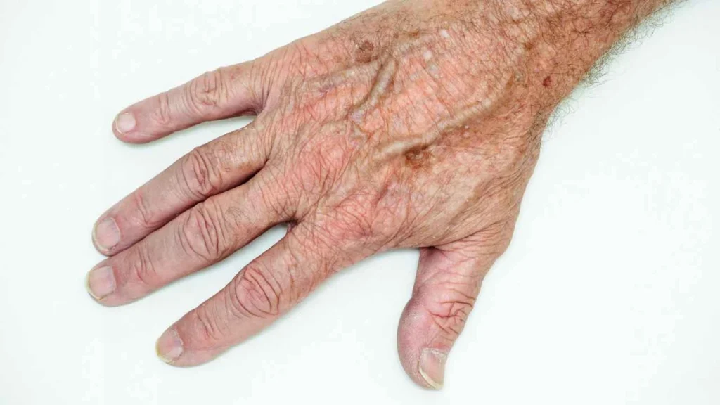 Male hand showing age spot Southall