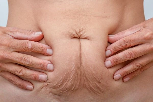 Image of a woman's stomach with loose skin - example of skin tightening Southall options