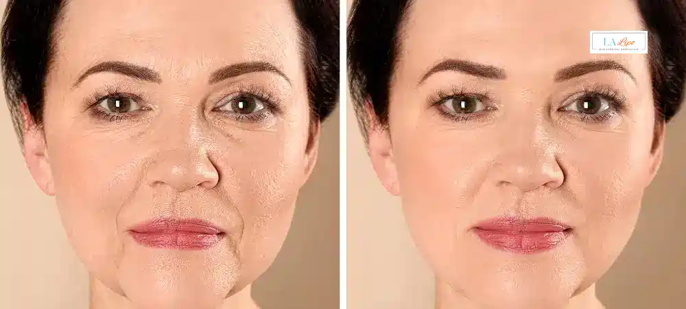 How Long Does It Take to See Results and How Long Do They Last Southall?